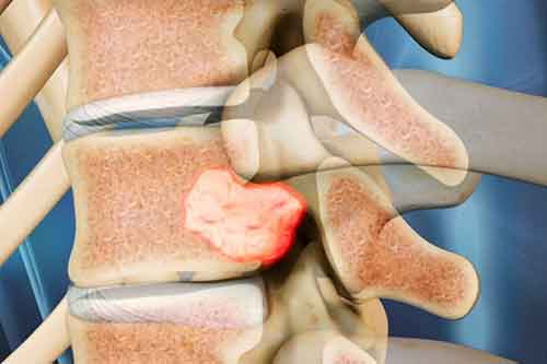 همانژیوم مهره های کمر چیست؟